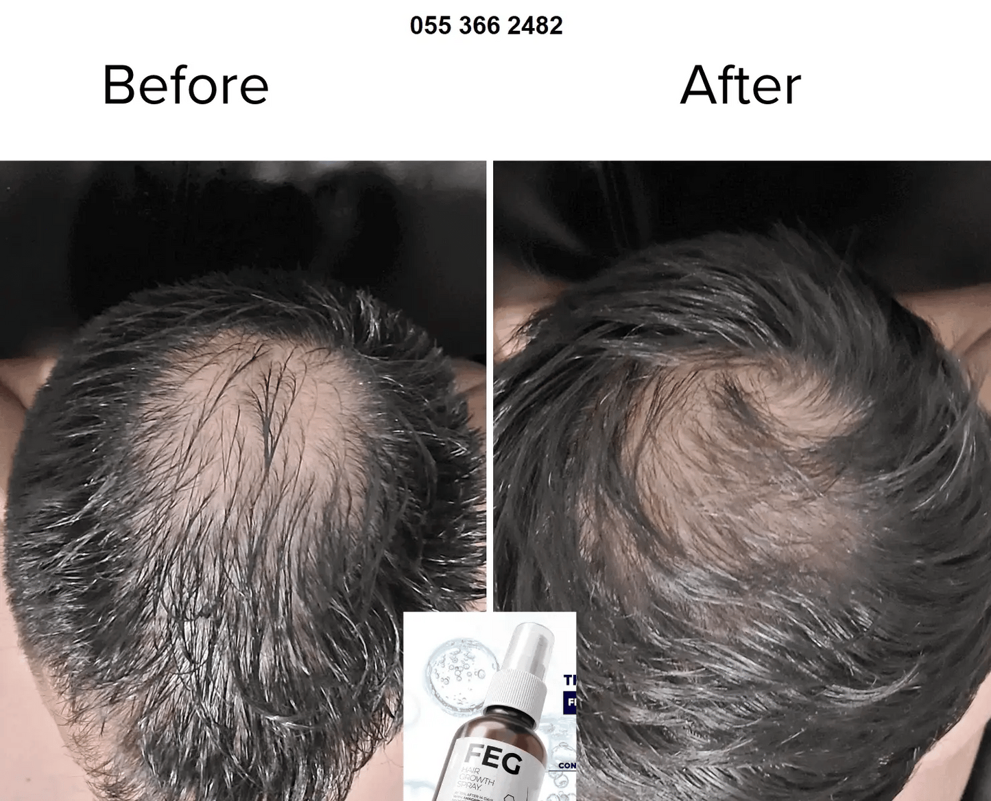 FEG Hair Growth Spray Plus With Free Derma Roller, Suitable For Both Men and Women