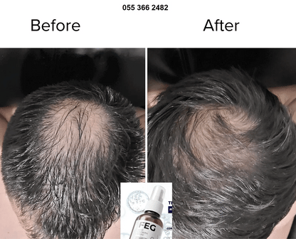 FEG Hair Growth Spray Plus With Free Derma Roller, Suitable For Both Men and Women